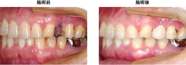 症例1　第一小臼歯の欠損症例