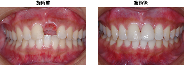 症例2　前歯部の欠損症例