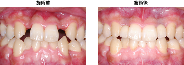 症例3　上顎両側切歯の欠損症例