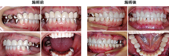 症例4　下顎臼歯部欠損症例